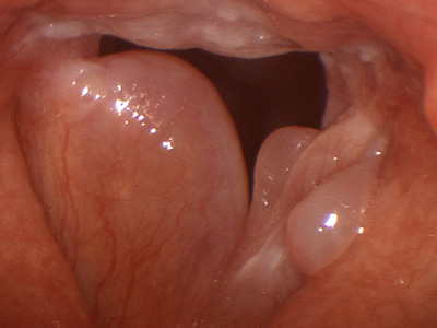 REINKE 3